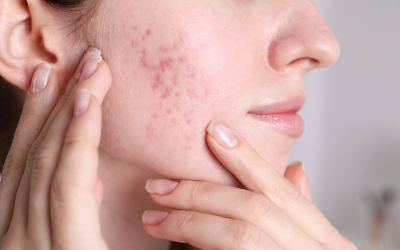 Find Acne Treatment in Hadapsar