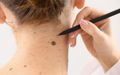 Find Best Mole Removal Treatment in Hadapsar