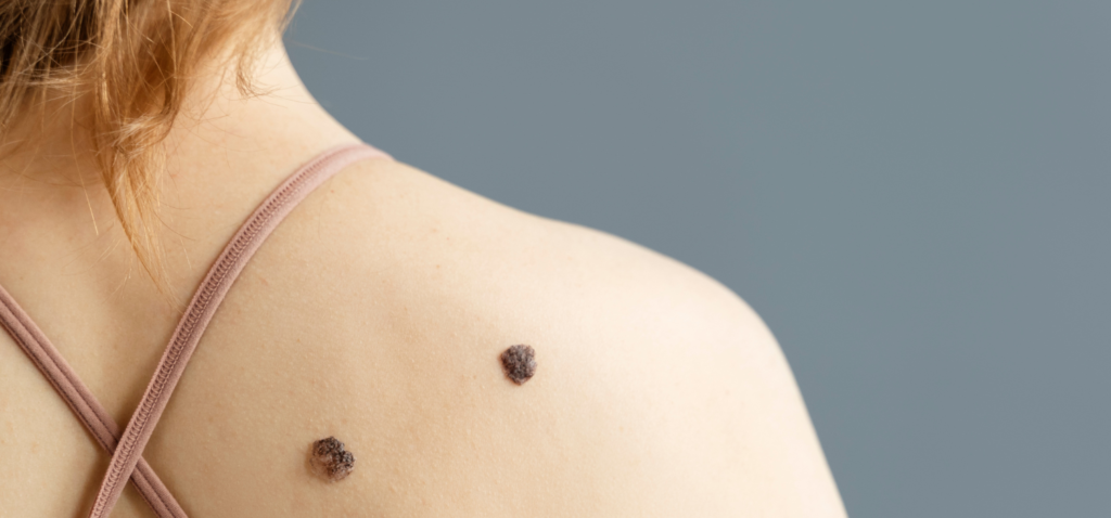 Mole Removal Treatment Aftercare: What You Need To Know
