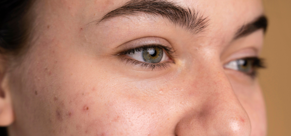 Why Do Some Acne Treatments Work Better Than Others?