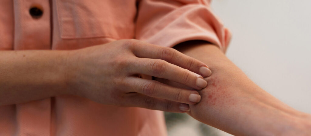 How to Manage Skin Allergies and Reactions